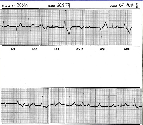 bigeminismo ventricular