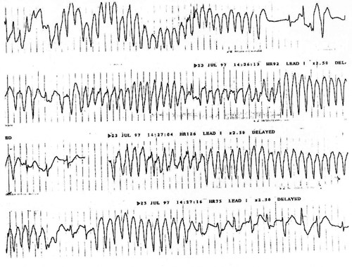 taquicardia ventricular polimórfica